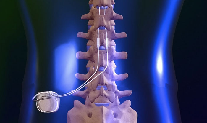 RPC_Spinal_Cord-Stimulator_Overview