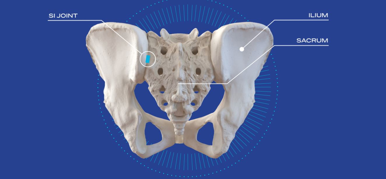 minimally-invasive-sacroiliac-joint-stabilization